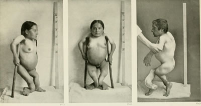 <p><strong>3</strong>.  İnsan kalıtımının bilgi hazinesi, 1909. M.B. 40 yaşında kadın, boy 86 cm,  M.B. nin erkek kardeşi boy 96 cm. El ve ayaklarda, uzun kemiklerde görülen  eğriliğin eşlik ettiği raşitizmli cüce kardeşlerde görülen büyüme<br />Kaynak: commons.wikimedia.org/wiki/File:Treasury_of_human_inheritance_(1909)_(14596814347).jpg?uselang=tr [Erişim: 10.01.2017] 